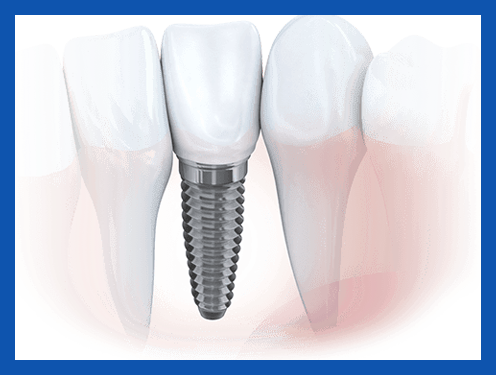 service, Dental Implants, 1st image left