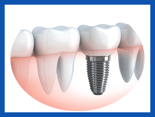 service, Dental Implants, 2nd image left