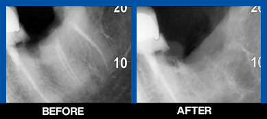 service, Tooth Extraction, 2st image right wali, before after (NEw)