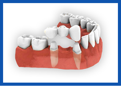 services, Crown & Bridge, Dental Bridge (right image)