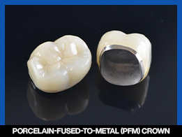 services, Crown & Bridge, mid , Porcelain-fused-to-Metal (PFM) Crown