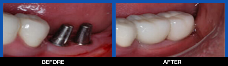 https://www.pearldentlko.com/wp-content/uploads/2024/08/services-Dental-Implants-bottom-before-after.jpg