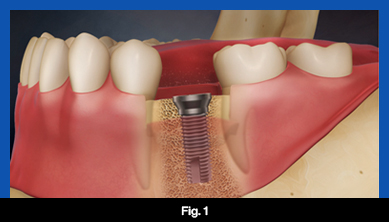 services, Dental Implants, middle, fig. 1