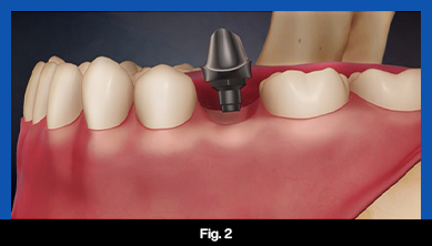 services, Dental Implants, middle, fig. 2