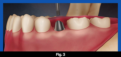 services, Dental Implants, middle, fig. 3