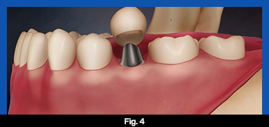 services, Dental Implants, middle, fig. 4