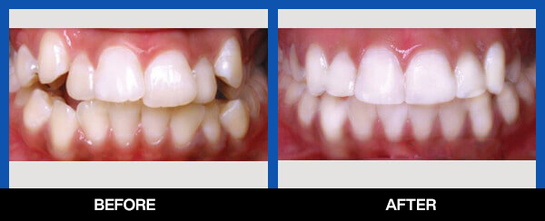 services, Orthodontic Treatment, first before after image