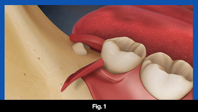 services, Tooth Extraction, fig 1 (teeth image)