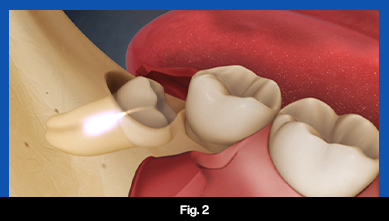 services, Tooth Extraction, fig 2 (teeth image)