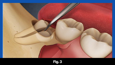 services, Tooth Extraction, fig 3 (teeth image)