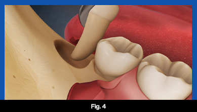 services, Tooth Extraction, fig 4 (teeth image)