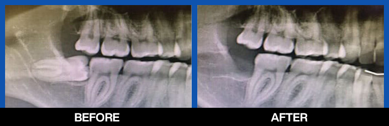 services, Tooth Extraction, last before after image