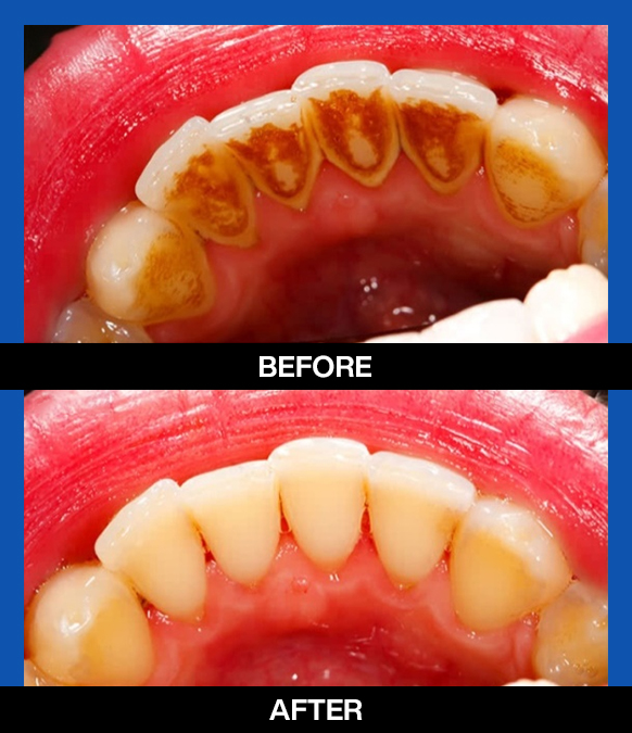 services , cosmetic dentist, scaling and polish, left 1st image 1