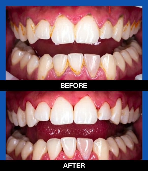 services , cosmetic dentist, scaling and polish, left 1st image.